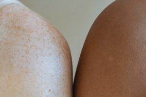 Body Positivity & Lipome