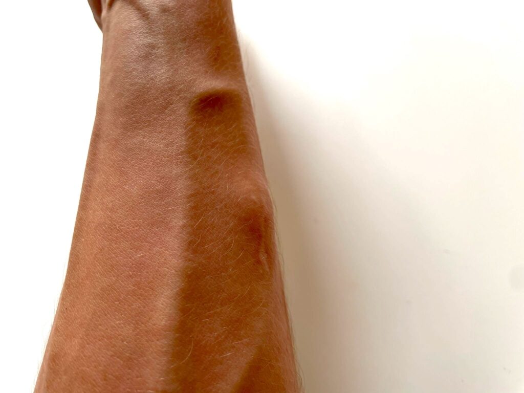 Ein Lipom am linken Unterarm