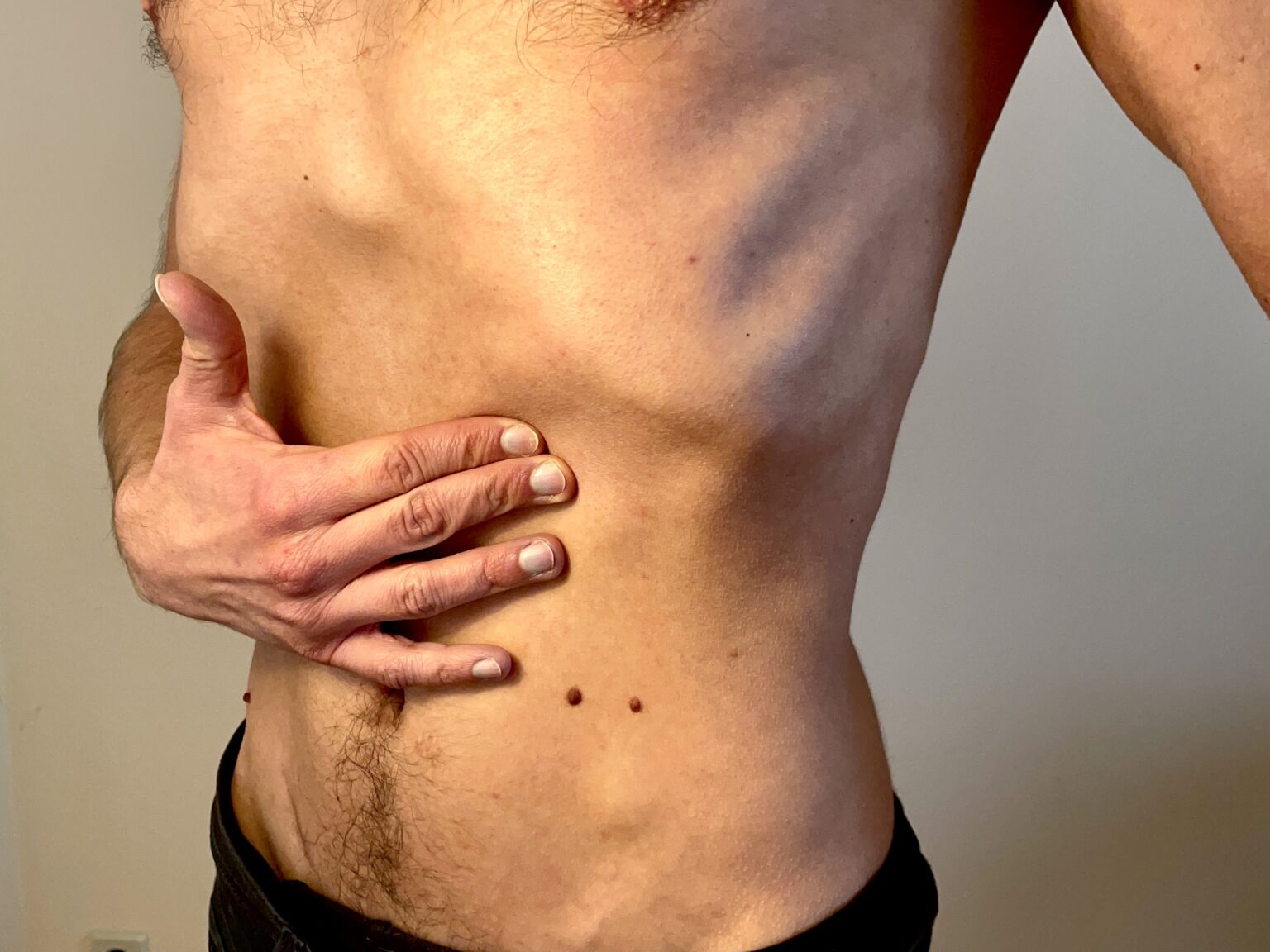 Knubbel Am Bauchnabel Unter Der Haut lipome.net